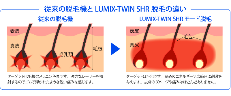 従来の脱毛機とLUMIX-TWIN SHR 脱毛の違い